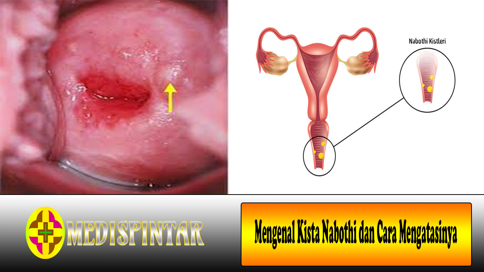 Mengenal Kista Nabothi dan Cara Mengatasinya