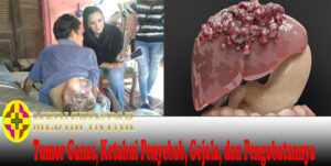Tumor Ganas, Ketahui Penyebab, Gejala, dan Pengobatannya