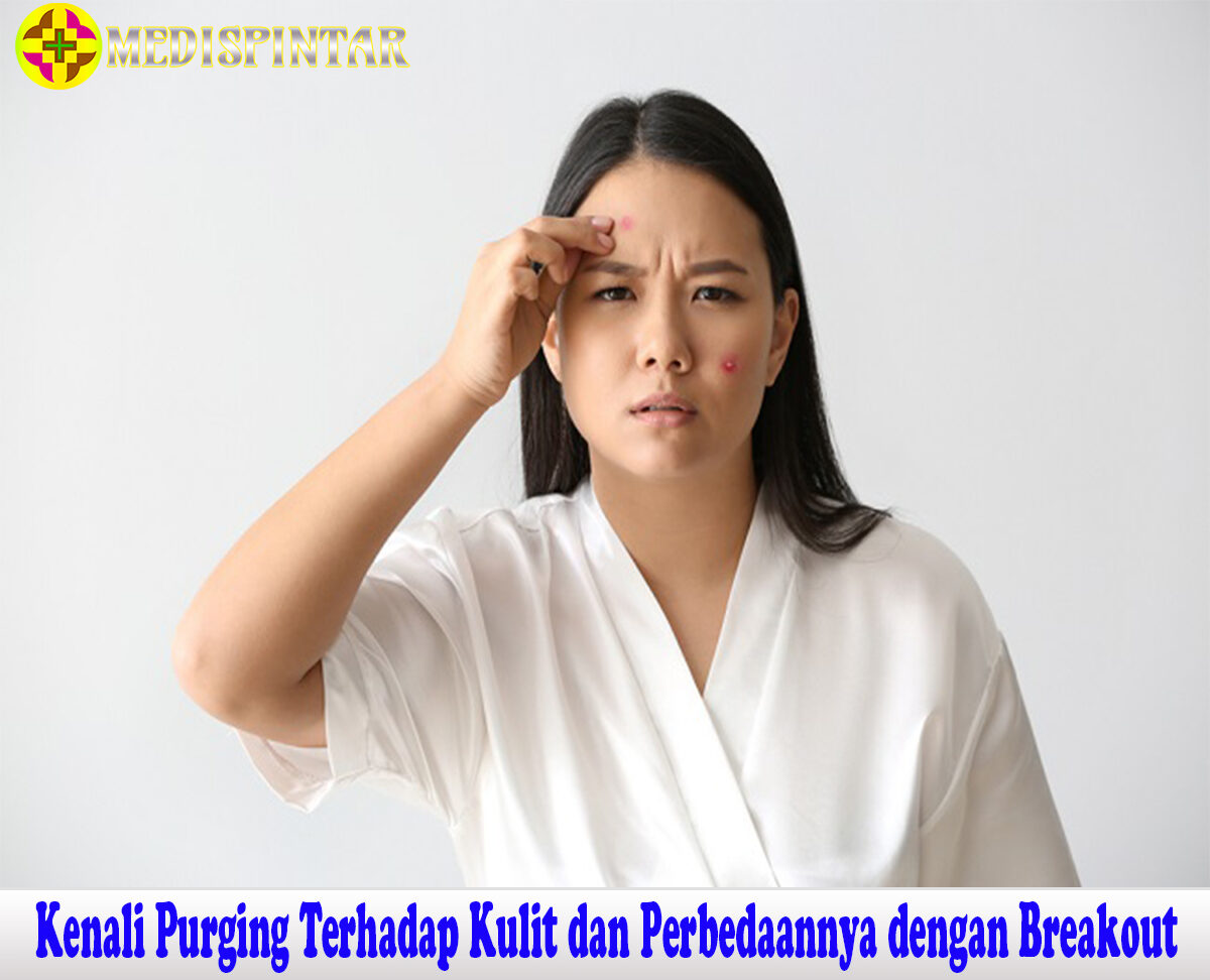 Kenali Purging Terhadap Kulit dan Perbedaannya dengan Breakout