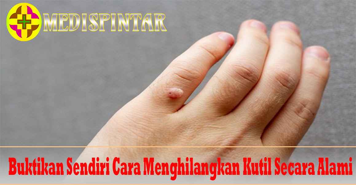 Buktikan Sendiri Cara Menghilangkan Kutil Secara Alami