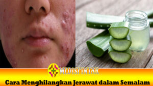 Cara Menghilangkan Jerawat dalam Semalam