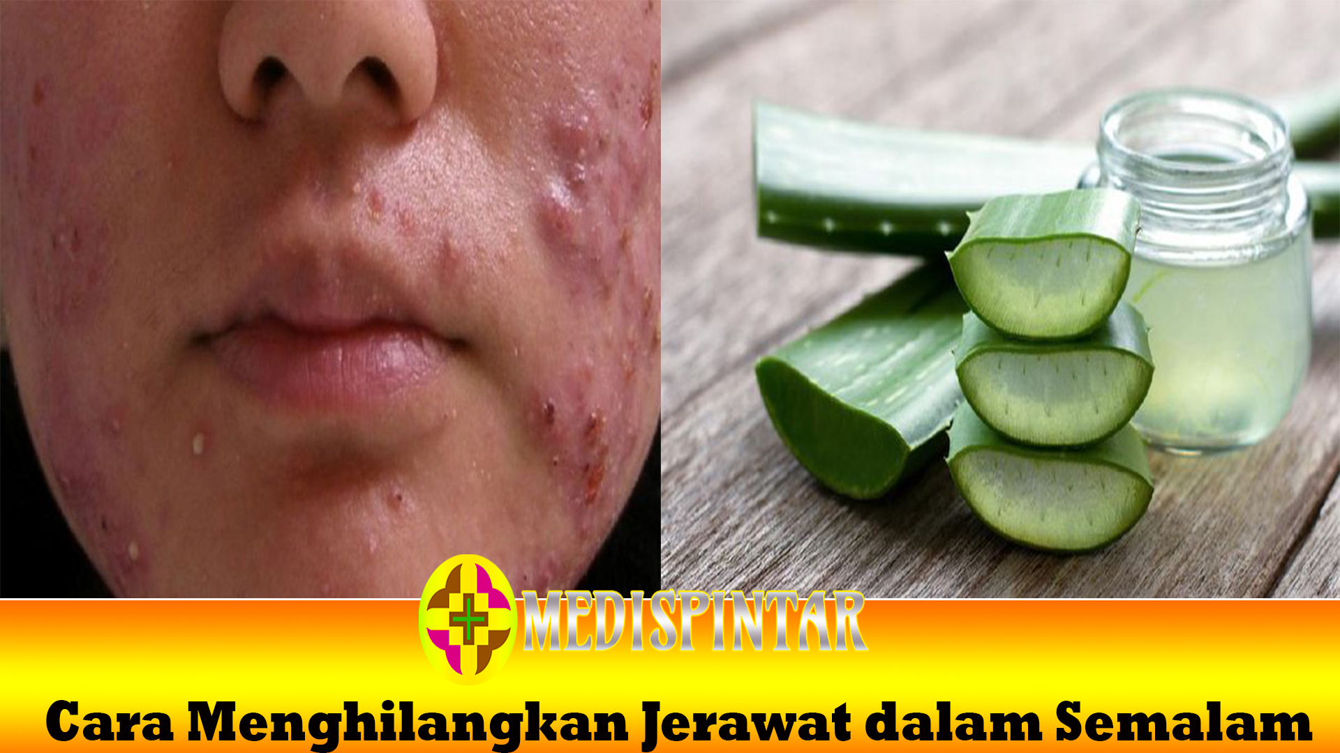 Cara Menghilangkan Jerawat dalam Semalam